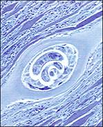 Trihineloza